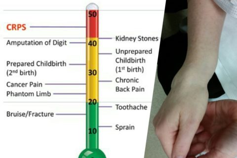 a pain scale on which CRPS is rated as more painful than childbirth, kidney stones, and amputation of a digit without anaesthetic