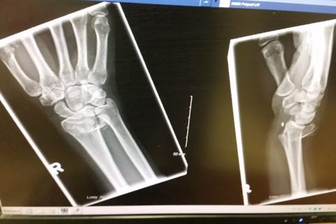 an x-ray of a fractured radius or broken arm