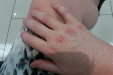 a woman's hand with red stripes, from inflammation, across all of the knuckles
