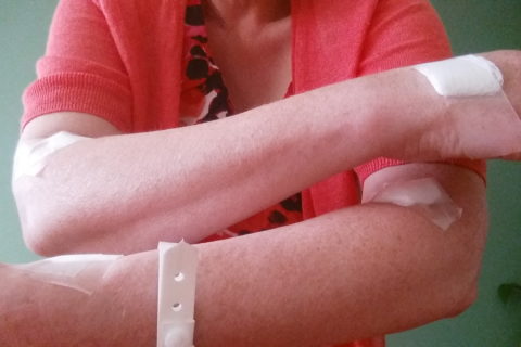 a woman with bandages on both arms, from multiple blood draws