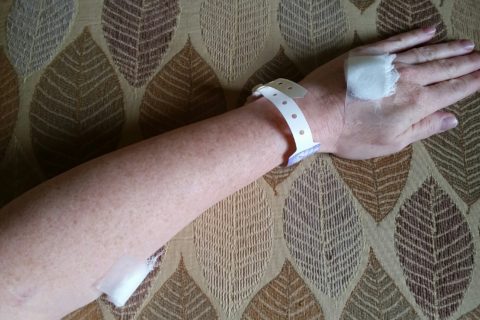a woman's hand bearing a hospital bracelet and several bandages from IVs during day-surgery