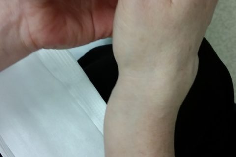 a woman's broken arm, with a bone sticking out near the wrist