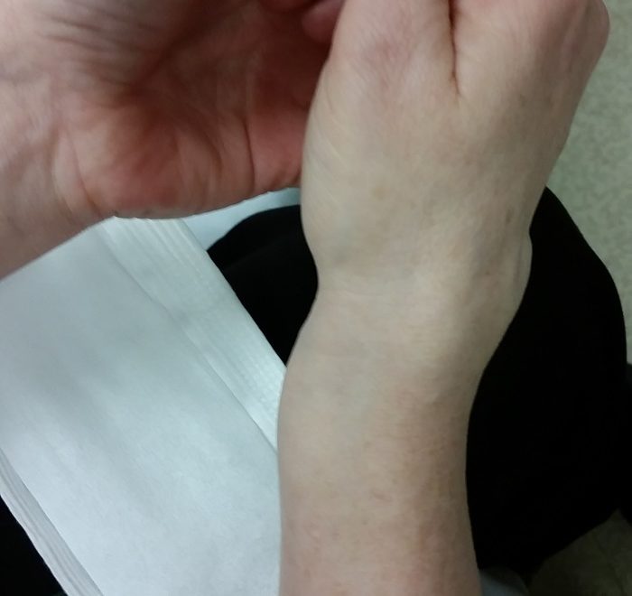 a woman's broken arm, with a bone sticking out near the wrist