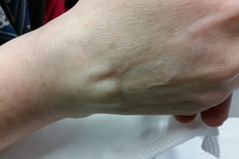 a woman's broken arm, with a bone sticking out near the wrist