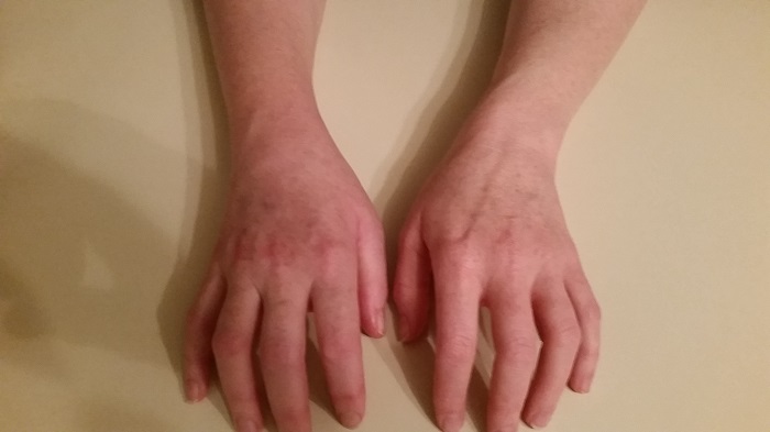 a woman's hand with severe swelling