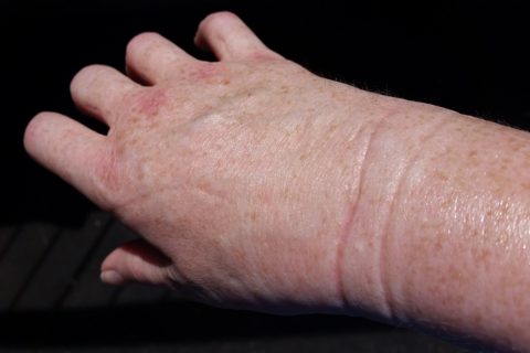a woman's wrist with severe swelling
