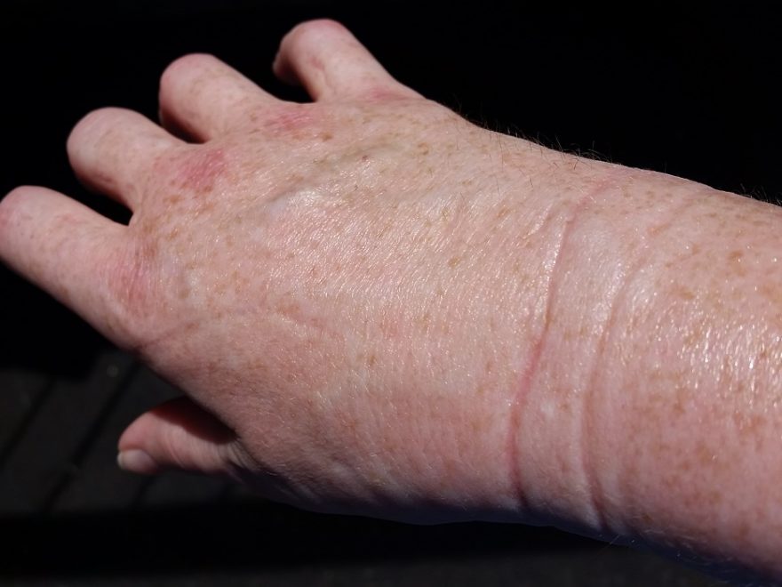 a woman's wrist with severe swelling