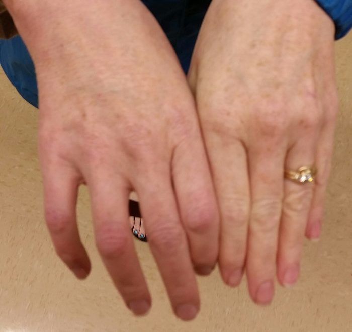 a very swollen and reddened woman's hand