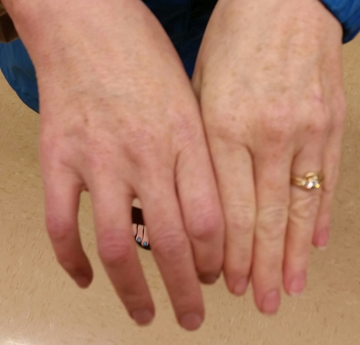 a very swollen and reddened woman's hand