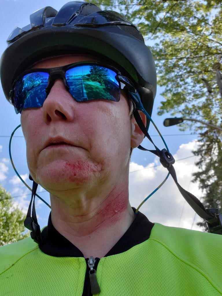 A woman wearing cycling helmet, sunglasses, and a neon yellow cycling top. She has bright red abrasions, deep scrapes, along the front and side of her neck as well as her chin.